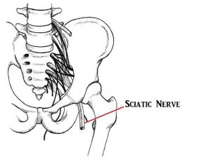 A medical illustration of the sciatic nerve