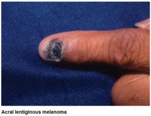 Close up photo of a fingernail with Acral lentiginous melanoma