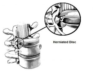 A medical illustration of a Herniated Disc