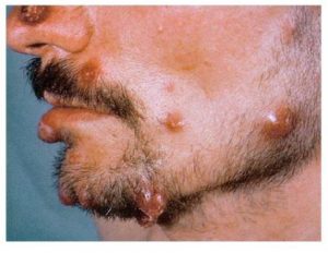 Close up photo of a man with Bacillary Angiomatosis
