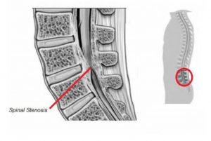 A medical illustration of spinal stenosis (choking of the spine)