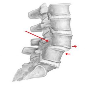 A medical illustration of the a slipped disc