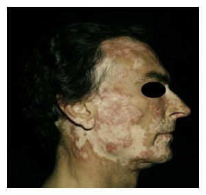 a photo of a face with Cutaneous Manifestations of Systemic Lupus Erythematosus
