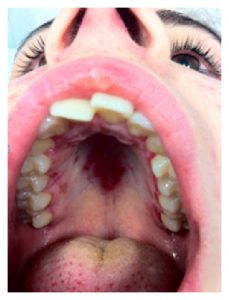 A close up photo of a mouth showing Cutaneous Manifestations of Systemic Lupus Erythematosus