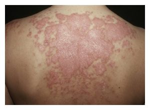 A photo of a back showing scarring from Cutaneous Manifestations of Systemic Lupus Erythematosus