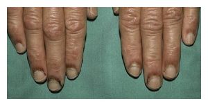 A photo showing fingerneail infections caused by Cutaneous Manifestations of Systemic Lupus Erythematosus