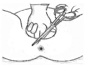 A diagram showing how the episiotomy is done