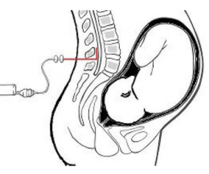 A diagram showing where the epidural is inserted