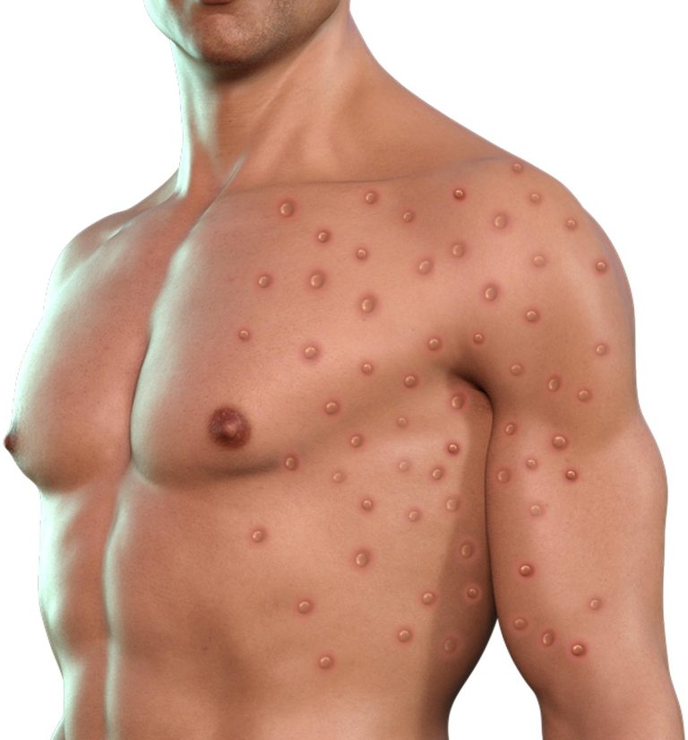 A digital representation of the sores caused by Monkey Pox.